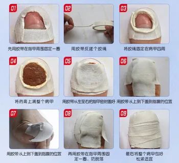 Ķīniešu Medicīna Garšaugi Pirksta Nagu Sēnīti Ārstēšanu, Pret Sēnīšu Nagu Infekciju Būtību, Nagu Ārstēšana Noņemšana Nagu Kopšanas Losjons