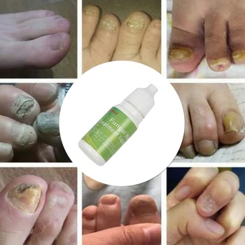 Ķīniešu Medicīna Garšaugi Pirksta Nagu Sēnīti Ārstēšanu, Pret Sēnīšu Nagu Infekciju Būtību, Nagu Ārstēšana Noņemšana Nagu Aprūpe